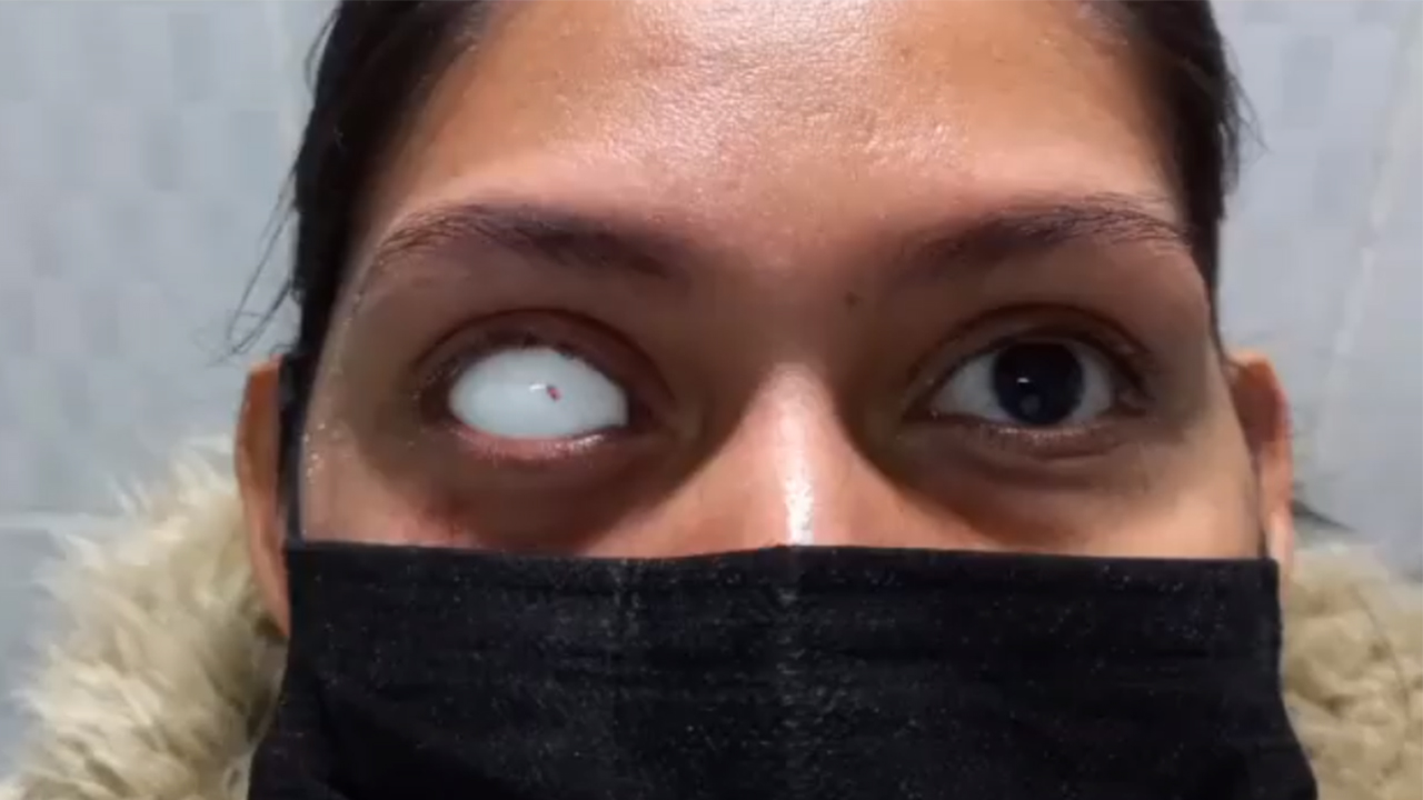 En este momento estás viendo Paciente con Perdida bulbo ocular derecho por Úlcera Córneal